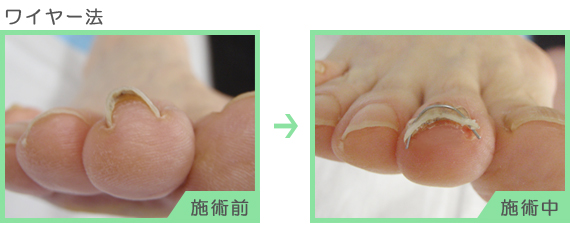 巻爪治療：ワイヤー法